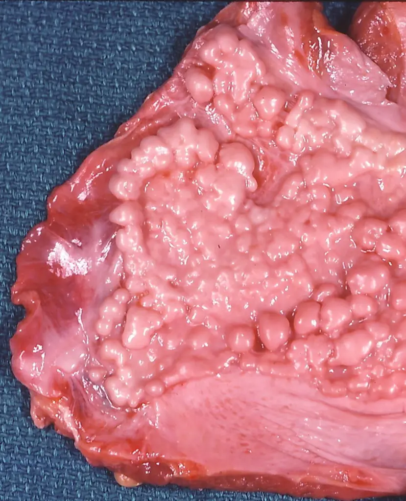 Asbestosis